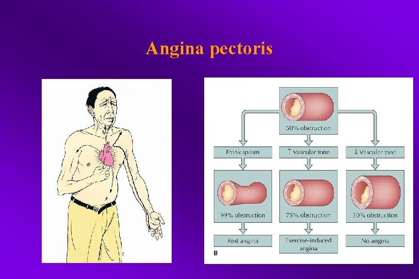 Angina pectoris 