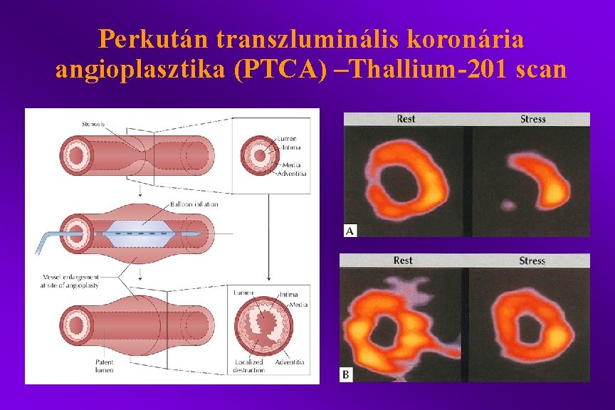 Perkután transzluminális koronária angioplasztika (PTCA) –Thallium-201 scan 