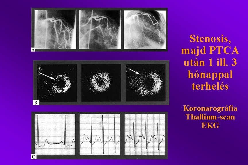 Stenosis, majd PTCA után 1 ill. 3 hónappal terhelés Koronarográfia Thallium-scan EKG 