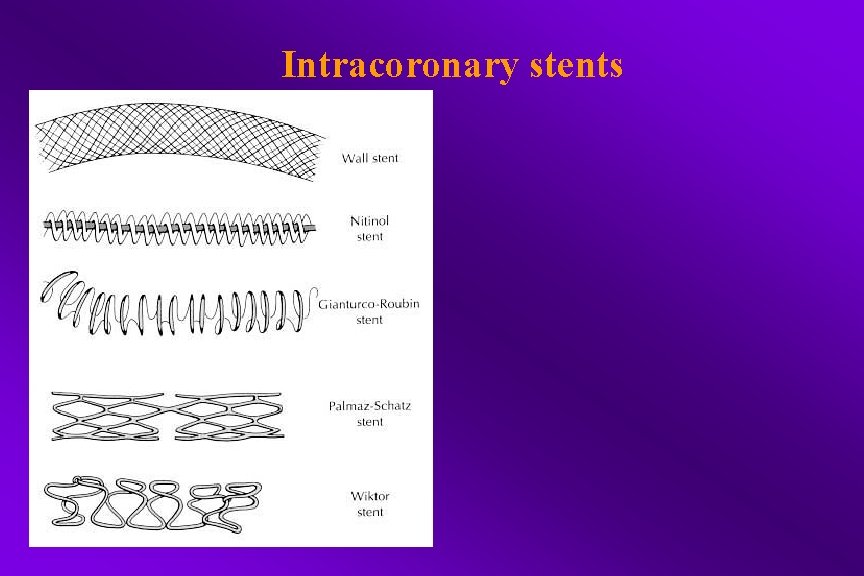 Intracoronary stents 