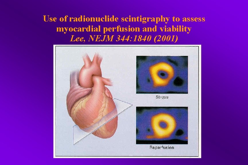 Use of radionuclide scintigraphy to assess myocardial perfusion and viability Lee, NEJM 344: 1840