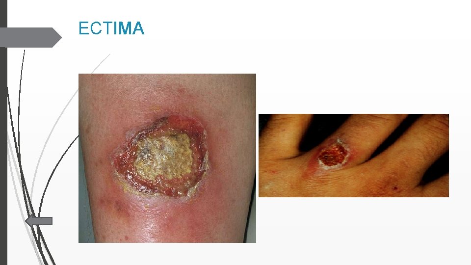 ECTIMA 