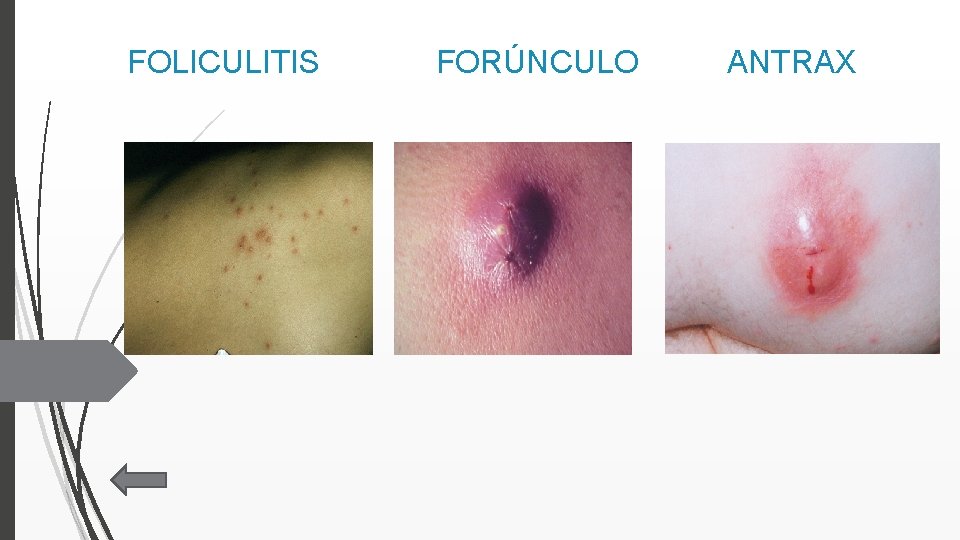 FOLICULITIS FORÚNCULO ANTRAX 