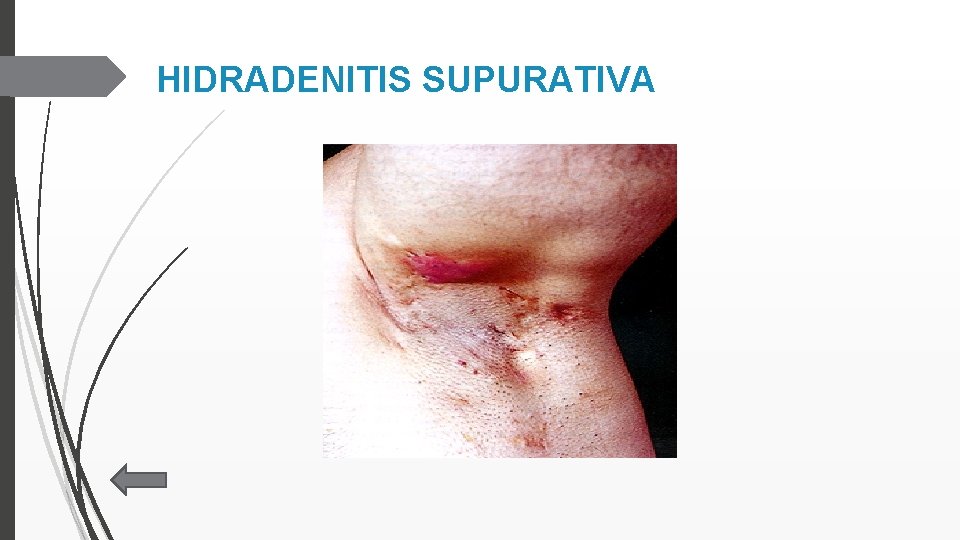 HIDRADENITIS SUPURATIVA 
