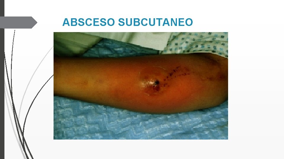 ABSCESO SUBCUTANEO 