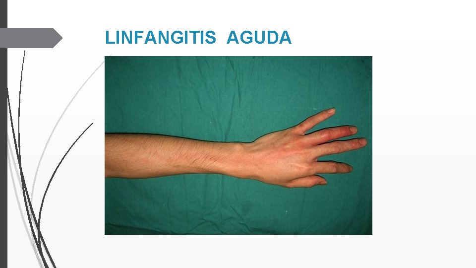 LINFANGITIS AGUDA 