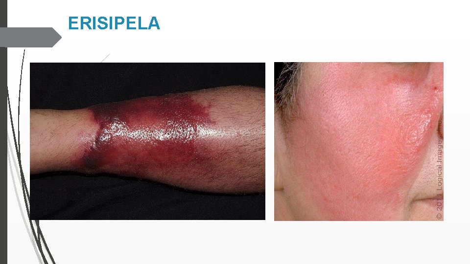 ERISIPELA 