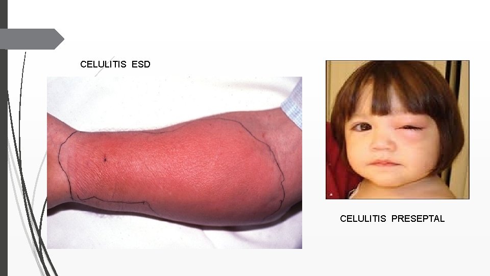 CELULITIS ESD CELULITIS PRESEPTAL 