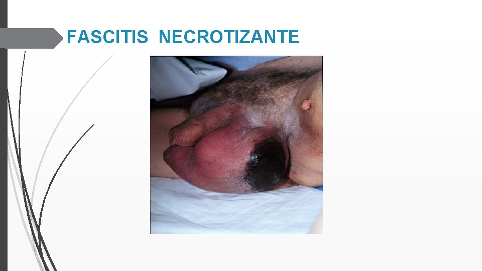 FASCITIS NECROTIZANTE 