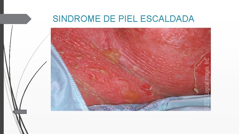 SINDROME DE PIEL ESCALDADA 