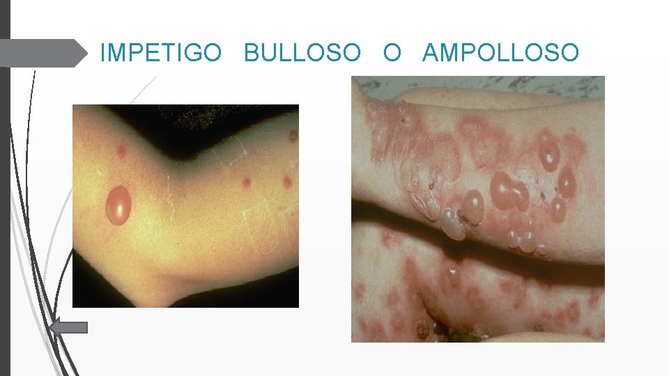 IMPETIGO BULLOSO O AMPOLLOSO 