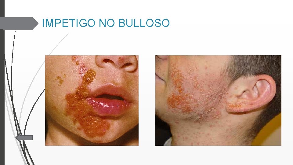 IMPETIGO NO BULLOSO 