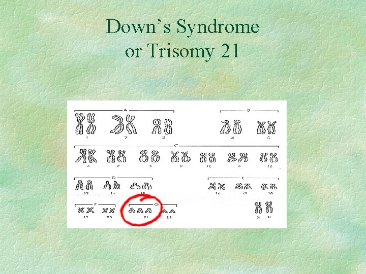 Down’s Syndrome or Trisomy 21 