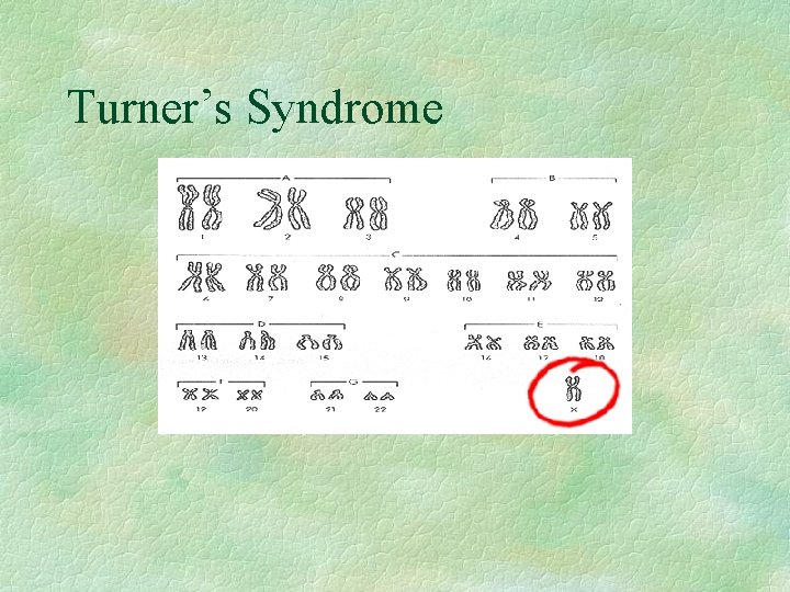 Turner’s Syndrome 