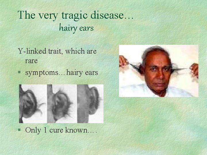 The very tragic disease… hairy ears Y-linked trait, which are rare § symptoms…hairy ears