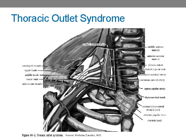 Thoracic Outlet Syndrome Source: Nicholas Zaorsky, M. D. 