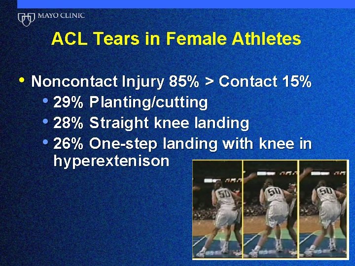 ACL Tears in Female Athletes • Noncontact Injury 85% > Contact 15% • 29%