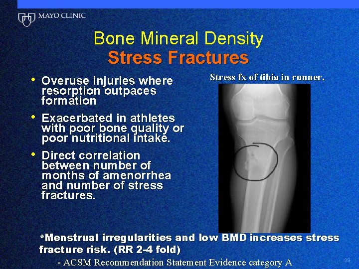 Bone Mineral Density Stress Fractures • Overuse injuries where • • Stress fx of