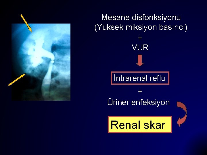 Mesane disfonksiyonu (Yüksek miksiyon basıncı) + VUR İntrarenal reflü + Üriner enfeksiyon Renal skar