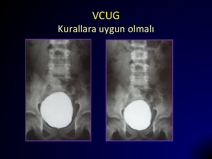 VCUG Kurallara uygun olmalı 