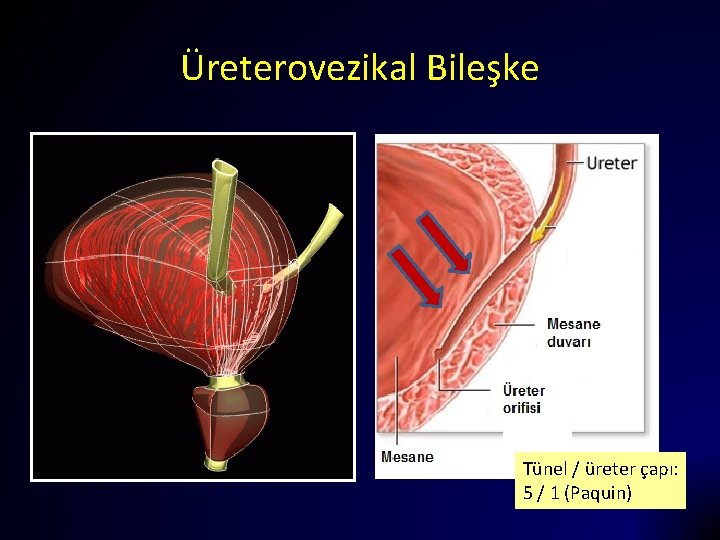 Üreterovezikal Bileşke Tünel / üreter çapı: 5 / 1 (Paquin) 