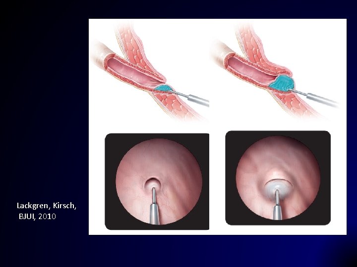 STING Lackgren, Kirsch, BJUI, 2010 