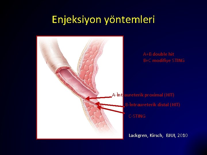 Enjeksiyon yöntemleri A+B double hit B+C modifiye STING A-İntraureterik proximal (HIT) B-İntraureterik distal (HIT)