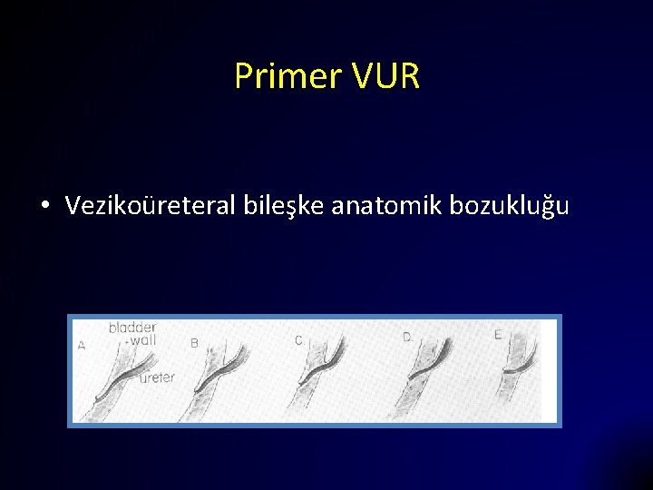 Primer VUR • Vezikoüreteral bileşke anatomik bozukluğu 