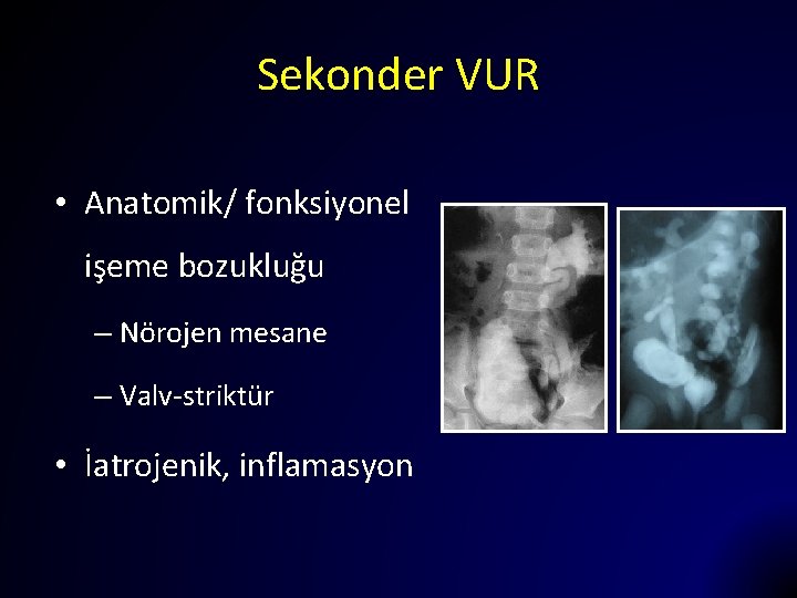 Sekonder VUR • Anatomik/ fonksiyonel işeme bozukluğu – Nörojen mesane – Valv-striktür • İatrojenik,