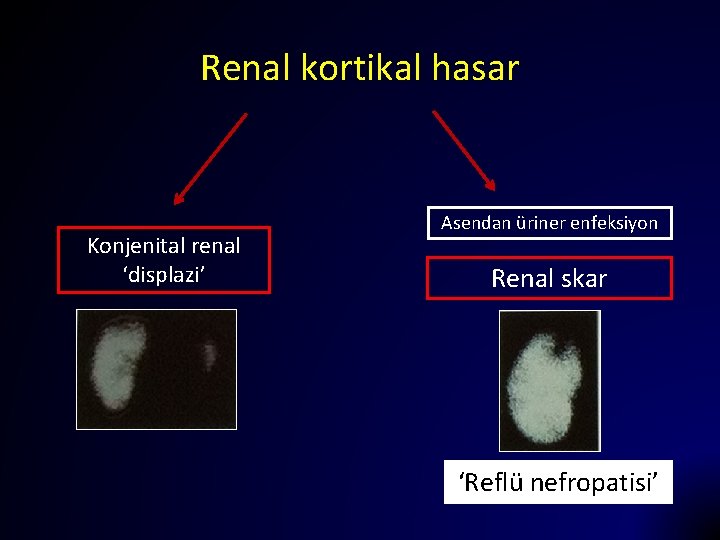 Renal kortikal hasar Konjenital renal ‘displazi’ Asendan üriner enfeksiyon Renal skar ‘Reflü nefropatisi’ 