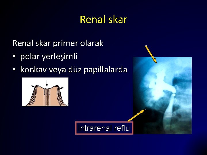 Renal skar primer olarak • polar yerleşimli • konkav veya düz papillalarda İntrarenal reflü