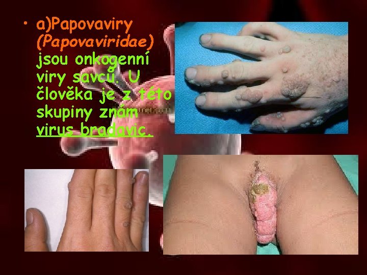  • a)Papovaviry (Papovaviridae) jsou onkogenní viry savců. U člověka je z této skupiny