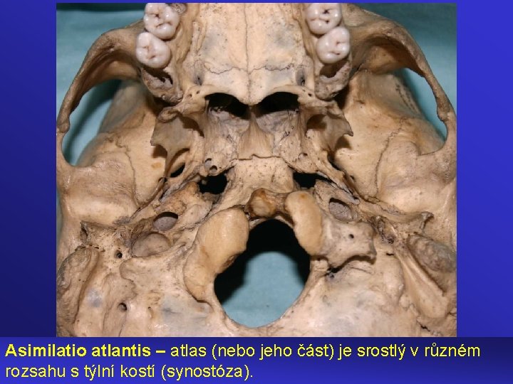 Asimilatio atlantis – atlas (nebo jeho část) je srostlý v různém rozsahu s týlní