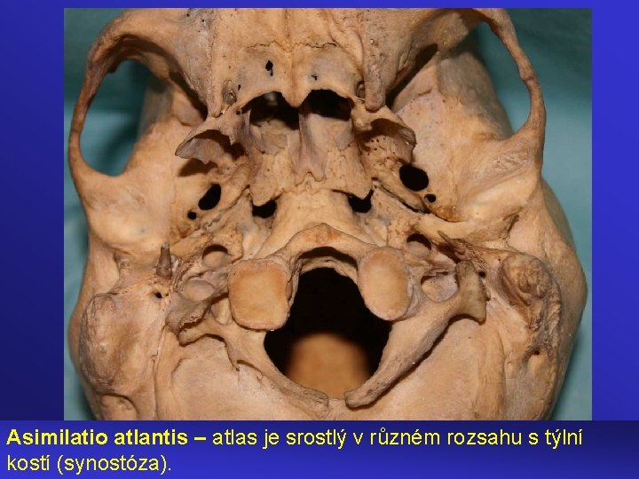 Asimilatio atlantis – atlas je srostlý v různém rozsahu s týlní kostí (synostóza). 