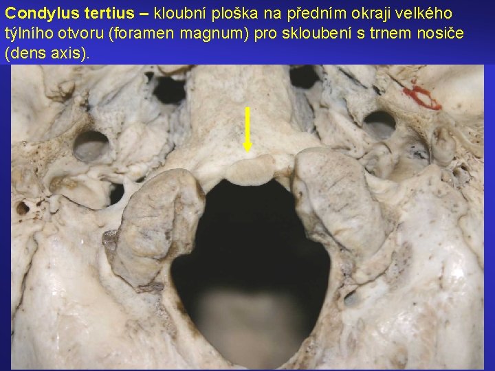 Condylus tertius – kloubní ploška na předním okraji velkého týlního otvoru (foramen magnum) pro
