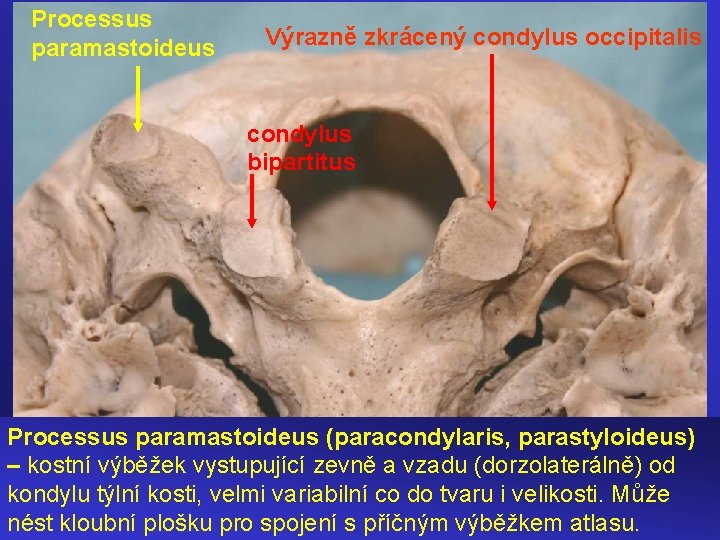 Processus paramastoideus Výrazně zkrácený condylus occipitalis condylus bipartitus Processus paramastoideus (paracondylaris, parastyloideus) – kostní