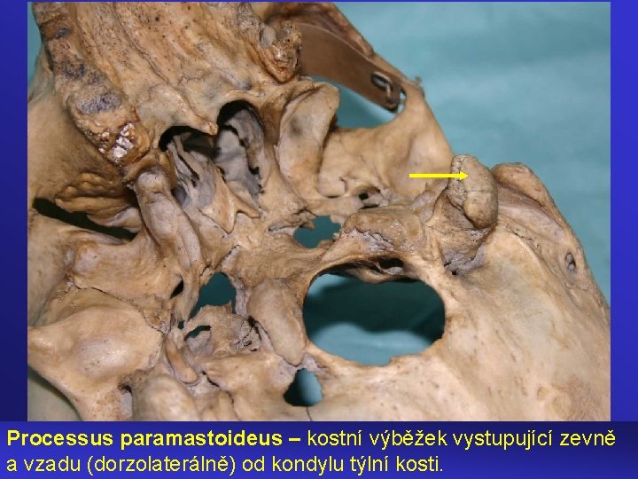 Processus paramastoideus – kostní výběžek vystupující zevně a vzadu (dorzolaterálně) od kondylu týlní kosti.