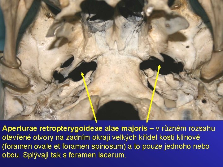 Aperturae retropterygoideae alae majoris – v různém rozsahu otevřené otvory na zadním okraji velkých