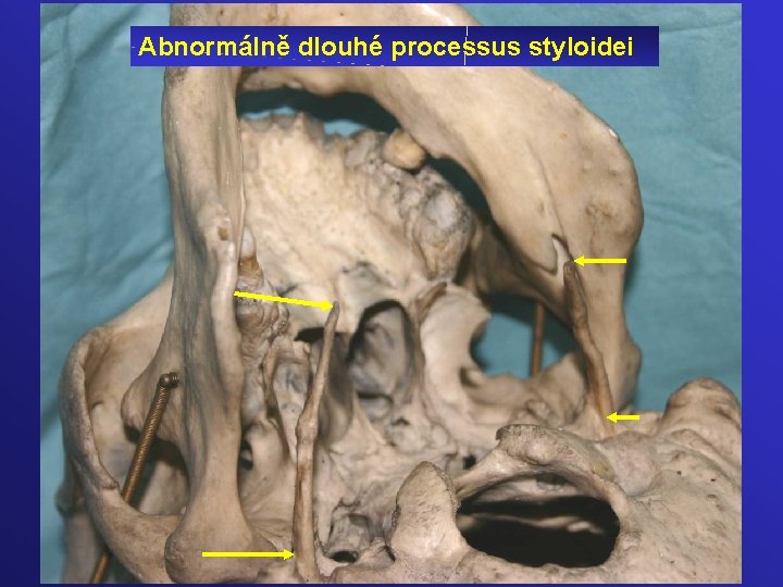 Abnormálně dlouhé processus styloidei 