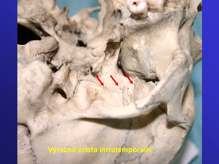 Výrazná crista infratemporalis 