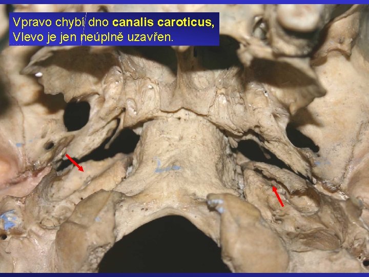 Vpravo chybí dno canalis caroticus, Vlevo je jen neúplně uzavřen. 