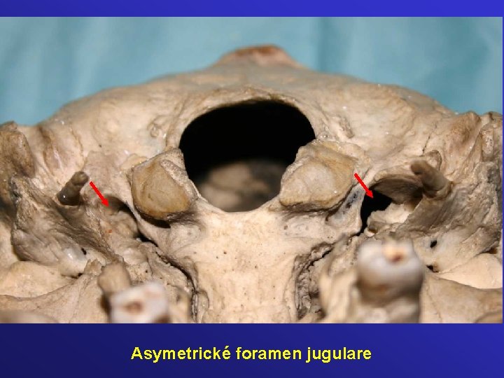 Asymetrické foramen jugulare 