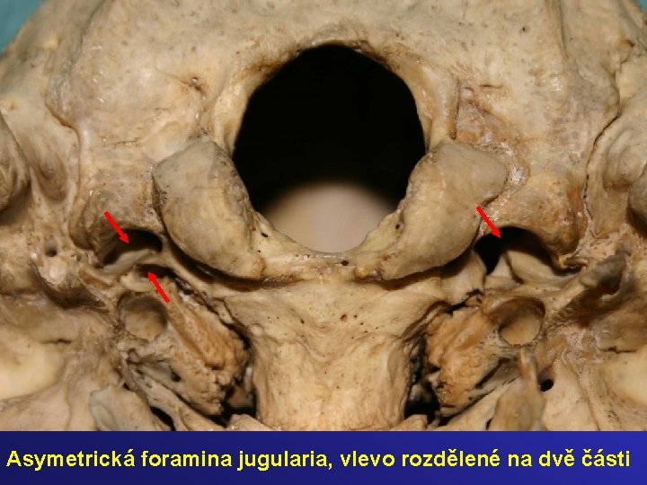 Asymetrická foramina jugularia, vlevo rozdělené na dvě části 