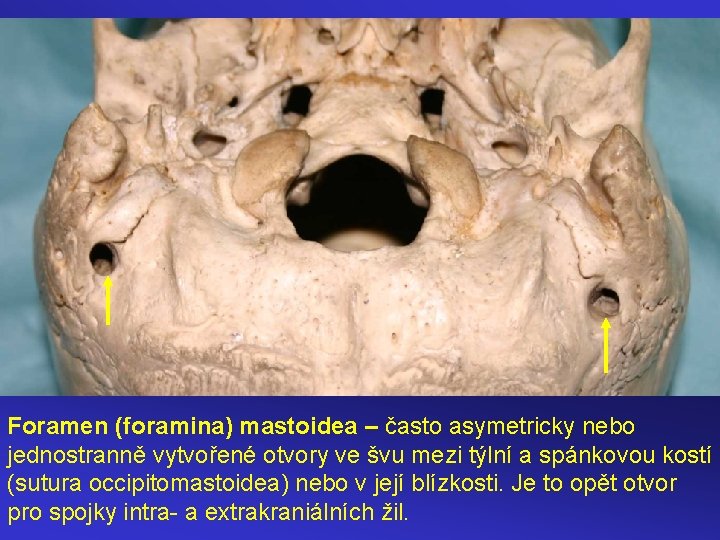 Foramen (foramina) mastoidea – často asymetricky nebo jednostranně vytvořené otvory ve švu mezi týlní