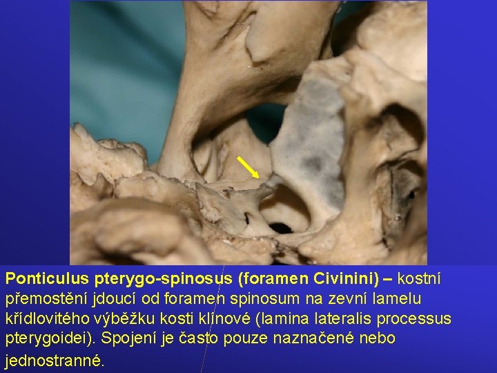 Ponticulus pterygo-spinosus (foramen Civinini) – kostní přemostění jdoucí od foramen spinosum na zevní lamelu
