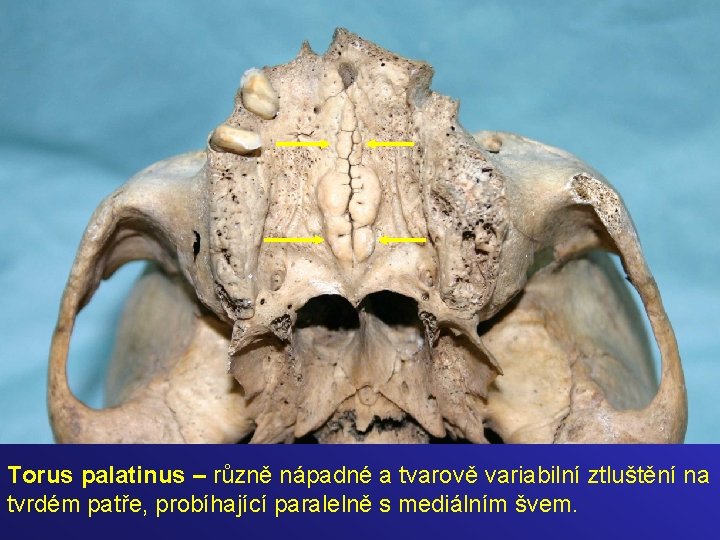 . Torus palatinus – různě nápadné a tvarově variabilní ztluštění na tvrdém patře, probíhající