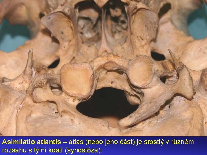 Asimilatio atlantis – atlas (nebo jeho část) je srostlý v různém rozsahu s týlní