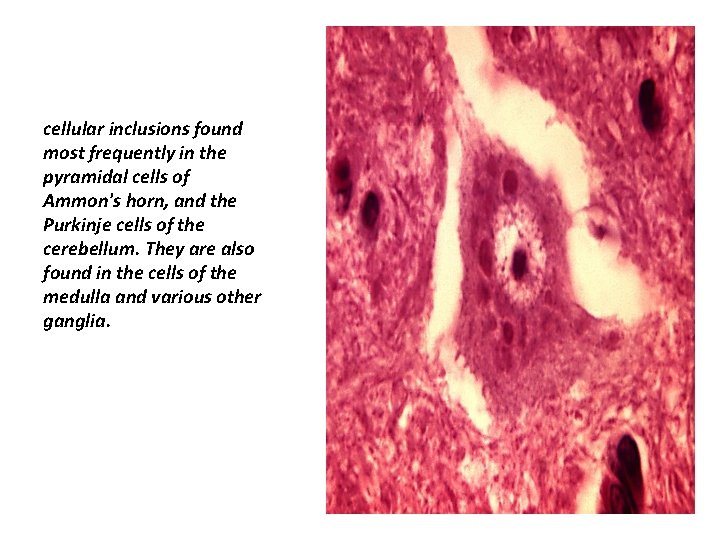 cellular inclusions found most frequently in the pyramidal cells of Ammon's horn, and the