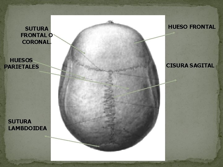 SUTURA FRONTAL O CORONAL. HUESOS PARIETALES SUTURA LAMBDOIDEA HUESO FRONTAL CISURA SAGITAL 