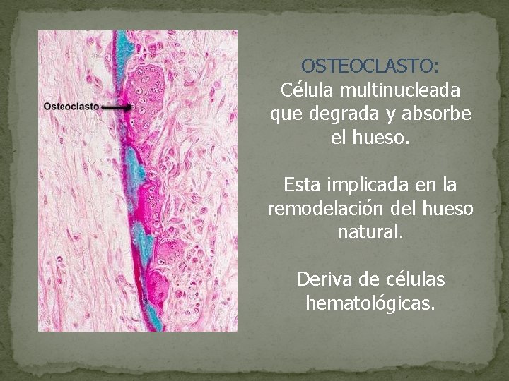 OSTEOCLASTO: Célula multinucleada que degrada y absorbe el hueso. Esta implicada en la remodelación